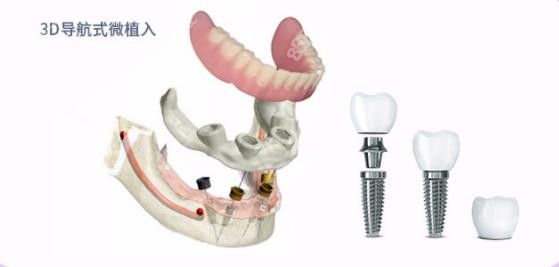 广州美莱口腔做种植牙技术采用数字化种植技术