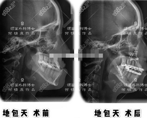 广州广大正颌手术真人实例