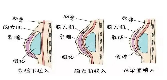 假体隆胸植入的几处地方