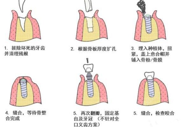 种植牙的方法步骤图解图片