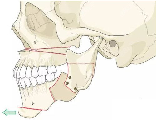 正颌手术动画示意图