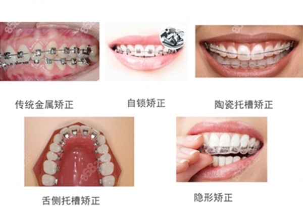 牙齿矫正的类型图