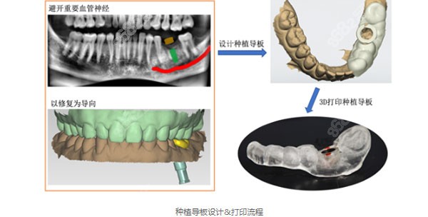 3D微创数字化导板种植