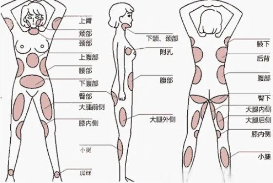 广州全身抽脂哪家医院比较好且正规