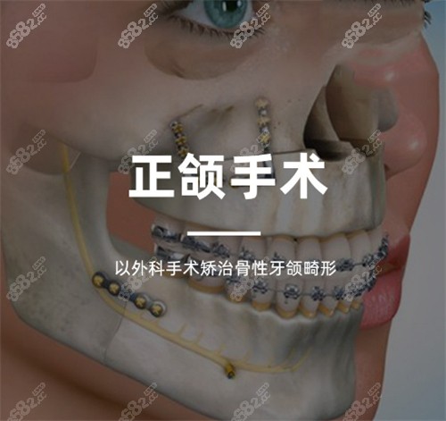 正颌手术宣传图