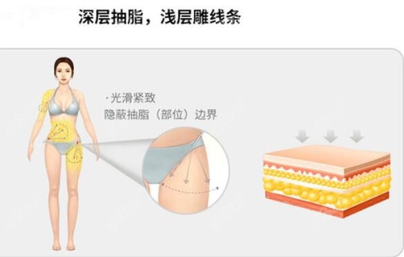 北京润美玉之光吸脂塑形