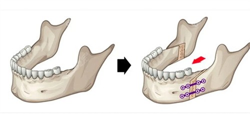 正颌手术示意图