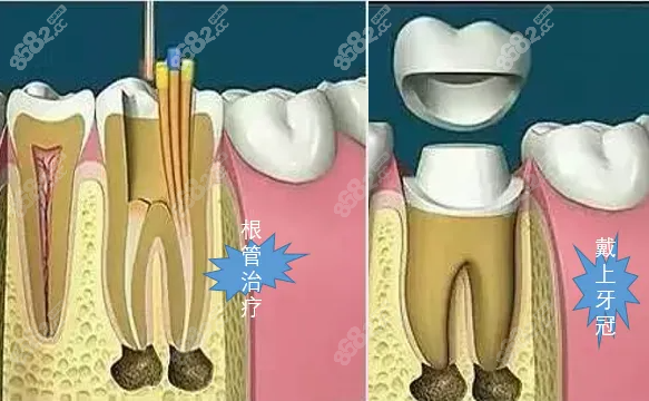 根管治疗的价格