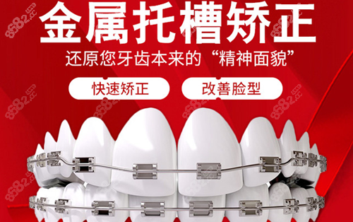 <!--<i data=20240705-sp></i>-->牙科金属托槽矫正 <!--<i data=20240705-sp></i>-->牙科金属托槽矫正