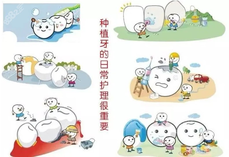种植牙护理重要性 种植牙护理重要性
