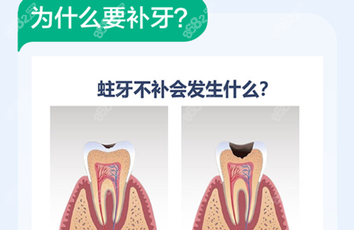 <!--<i data=20240705-sp></i>-->牙科补牙 <!--<i data=20240705-sp></i>-->牙科补牙