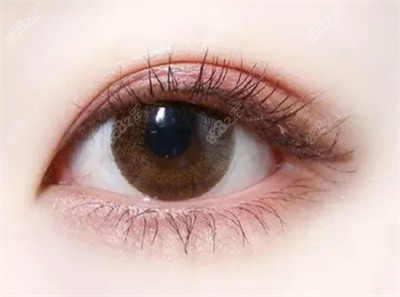 谢燕燕做双眼皮手术的技术优势2