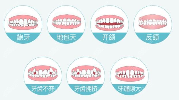 <!--<i data=20240705-sp></i>-->牙齿矫正适应人群