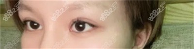 谢燕燕做双眼皮手术的技术优势4