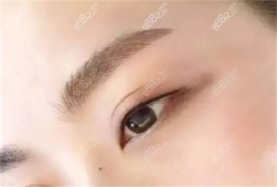 谢燕燕做双眼皮手术的技术优势1