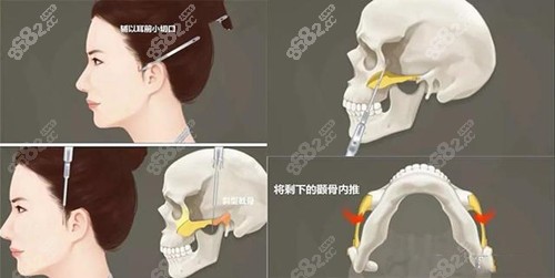 磨骨技术解析