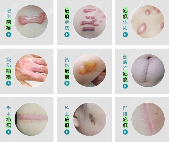 重庆骑士疤痕修复种类 重庆骑士疤痕修复种类