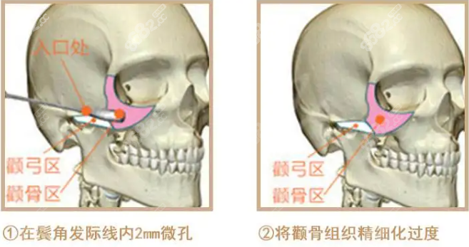 一针降颧骨操作图示