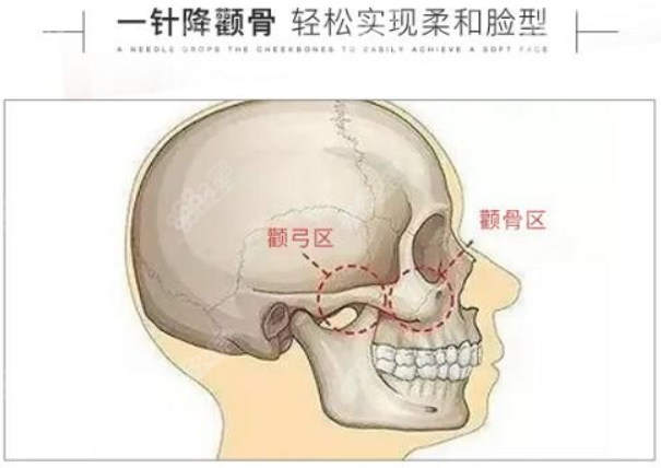 一针降颧骨术