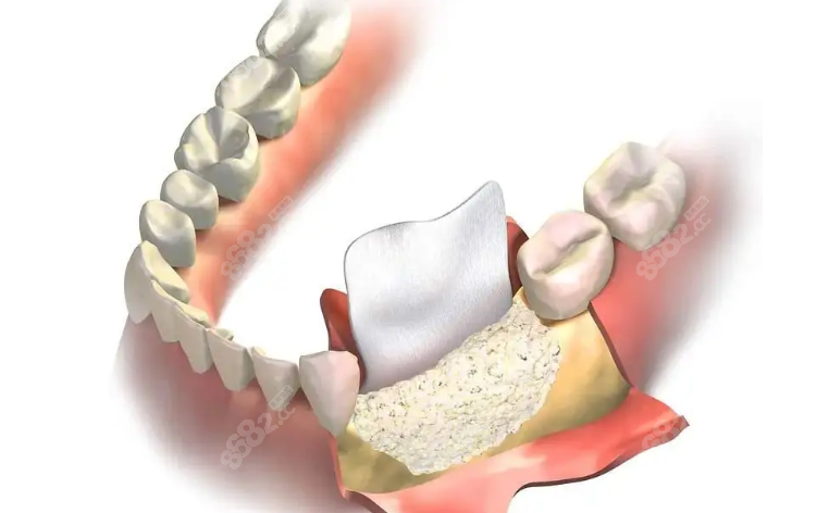 骨粉骨膜在牙槽骨内示意图