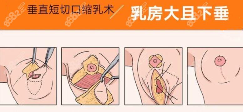 北京八大处穆大力缩胸手术过程