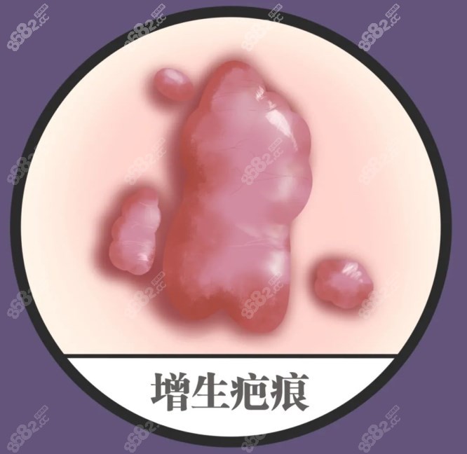 重庆华美祛除增生疤痕优势 重庆华美祛除增生疤痕优势