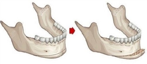 下颏整形示意图