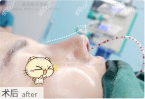 广州高尚余文林鼻子修复病例