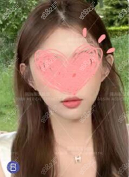 广州高尚余文林贴发耳矫正手术