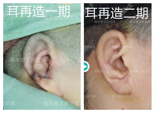 广州高尚余文林耳再造病例