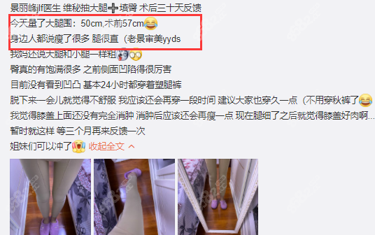 广州高尚景丽峰抽脂好评