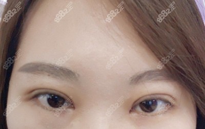 何山医生做双眼皮手术的技术优势2