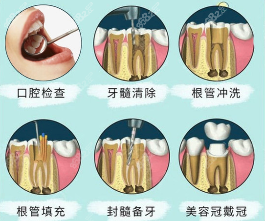 根管治疗流程