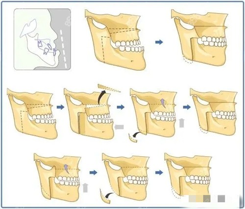 <!--<i data=20240705-sp></i>-->正颌手术咋样？