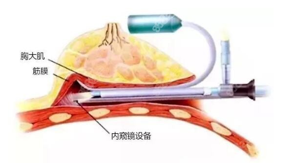 内窥镜隆胸