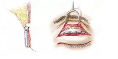 黄振银医生做双眼皮手术的技术优势1