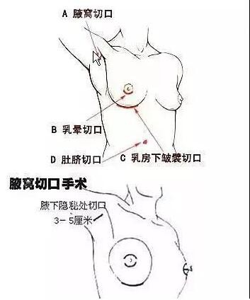 许扬滨医生隆胸切口