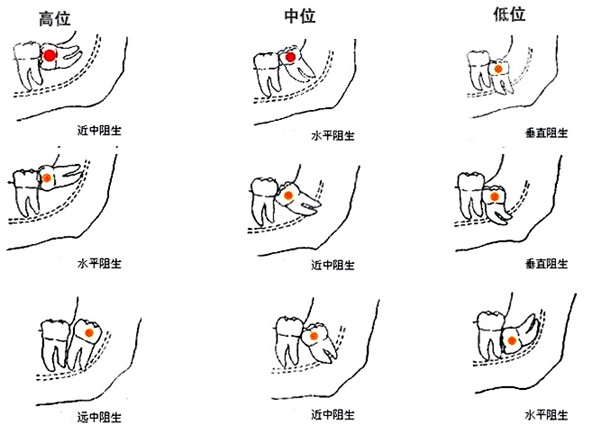 阻生智齿的生长位置图