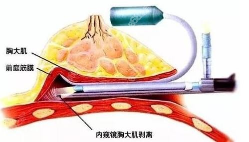 林沸腾内窥镜隆胸