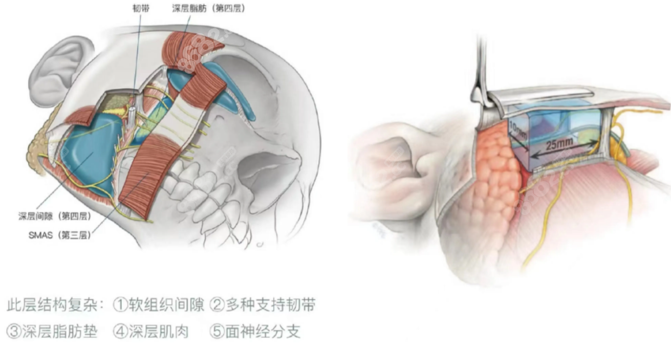 面部拉皮手术过程示意图