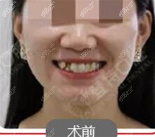 佛山登特口腔黄倩矫正前