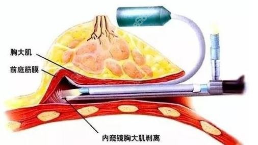 北京米兰柏羽丽都假体隆胸采用内窥镜隆胸术损伤小