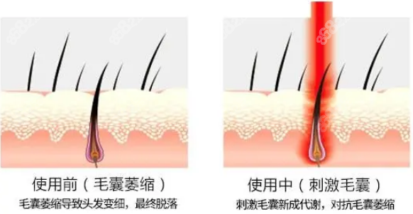 <!--<i data=20240705-sp></i>-->胡刚医生激光生发