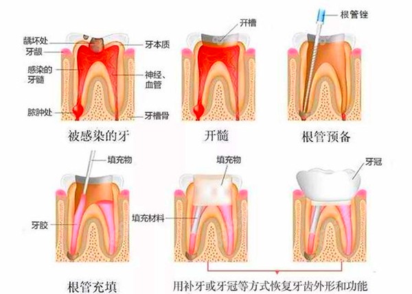 根管治疗的过程图