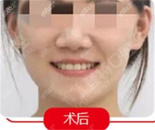 佛山登特口腔黄倩矫正后