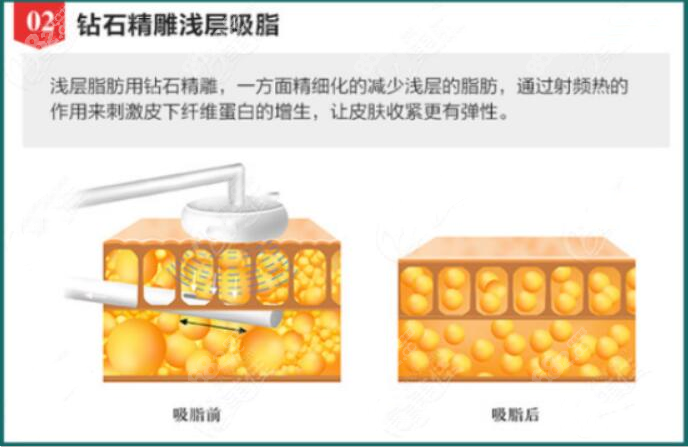 钻石精 雕浅层吸脂