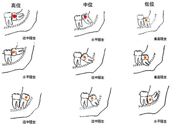 淮南口腔醫院收費標準內包含有淮南牙齒矯正多少錢哦