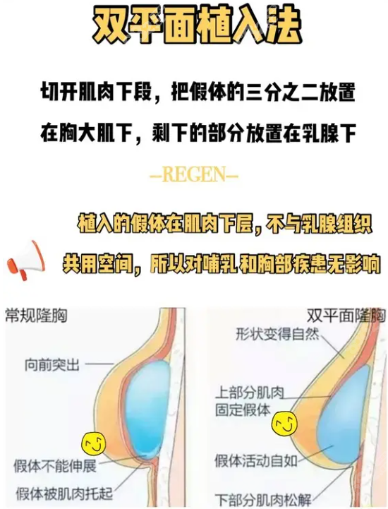 双平面假体隆胸的优势