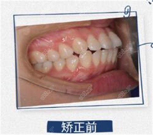 北京科尔口腔矫正前