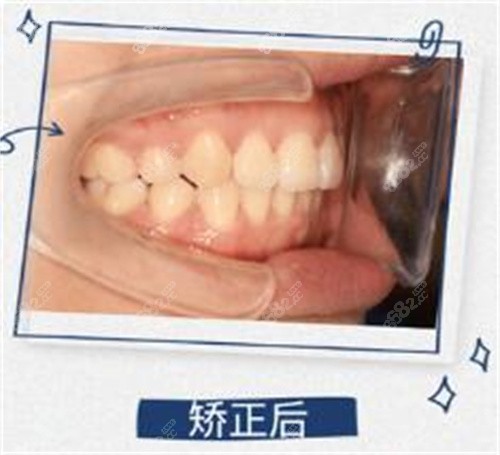北京科尔口腔矫正后